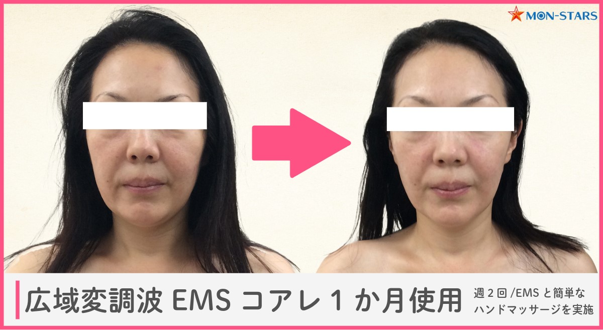 顔用EMSってどんな美容効果があるの？【1か月試した結果】 │ お役立ち