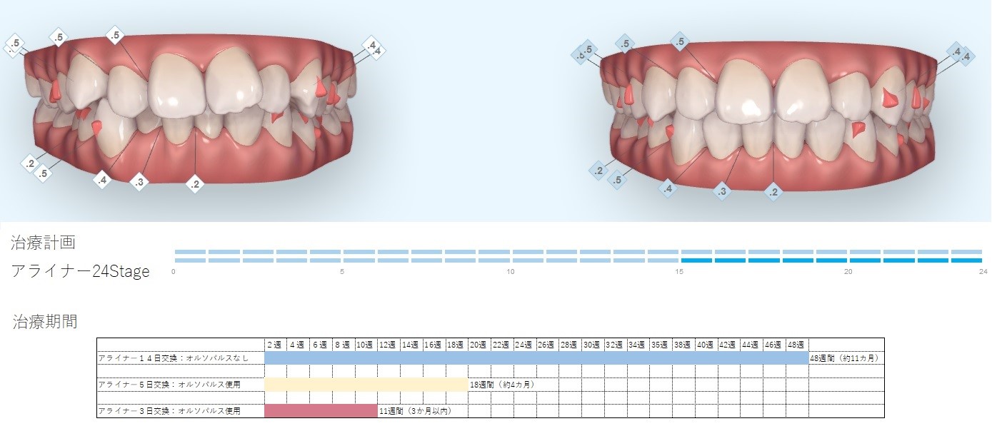 オルソパルス（光加速矯正装置）なら東京銀座ビアンコ矯正歯科