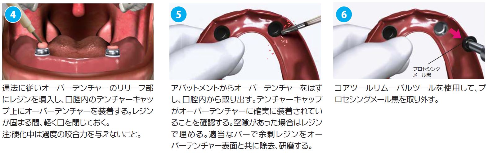 ロケーターアタッチメントシステム|株式会社インプラテックス