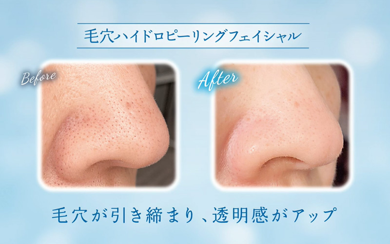 ハイドロピーリング | しろがねのりこ皮ふ科［皮膚科・アレルギー科