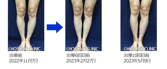 O脚・X脚治療プログラム-痛みの原因治療専門外来【細野クリニック