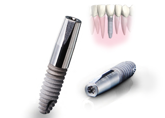インプラントは兵庫県神戸市灘区の神戸六甲インプラントテクニカル