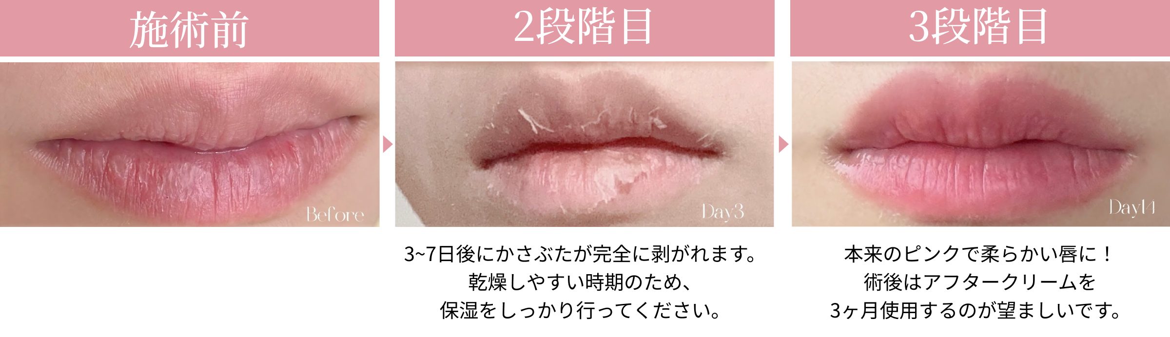 ローマピンク–エックスクリニック｜X CLINIC｜ エイジングケア・クマ