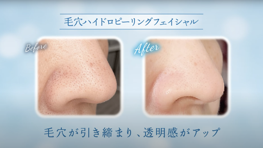 ハイドロスプラッシュ」で毛穴の頑固な汚れを徹底洗浄｜公式｜total