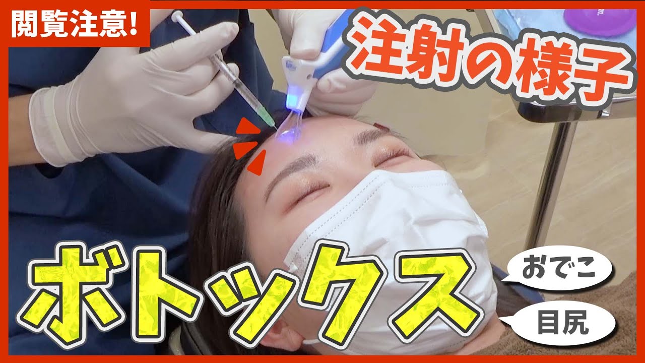 ボトックス注射】表情ジワ（眉間・おでこ・目尻）を抑える施術シーンを