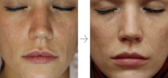 小顔・美肌効果が期待できるフラクショナルRF｜福岡 美容皮膚科 松田